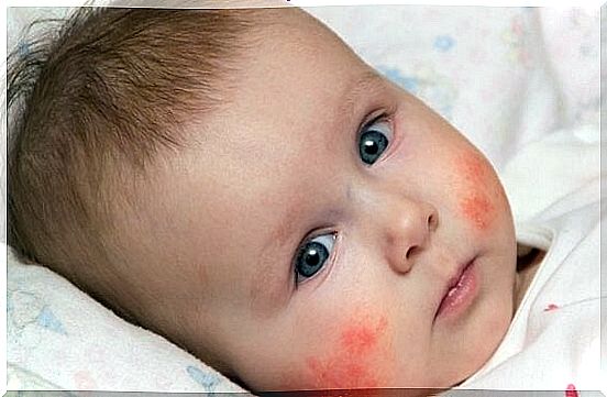 atopic dermatitis on a baby